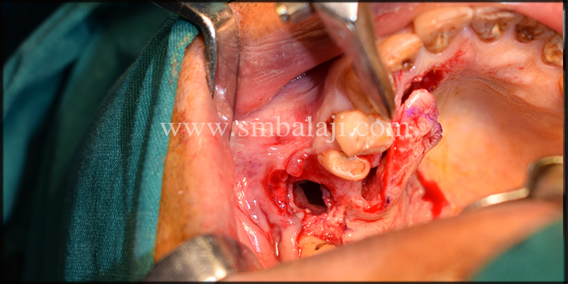 Full Thickness Palatal Flap Raised