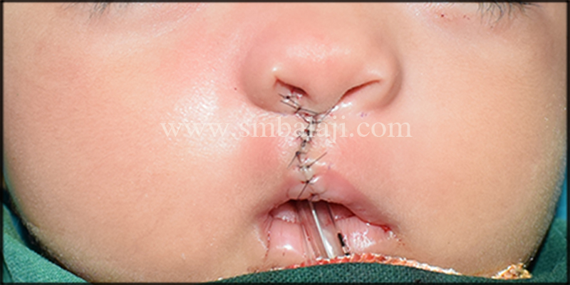 Primary Cleft Lip Repair Done Using Modified Millard’s Technique