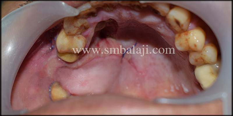 Immediate Post-Operative View Following Closure Of Oroantral Fistula