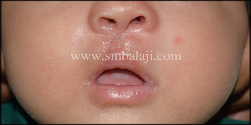 Immediately After Suture Removal Showing Improved Appearance
