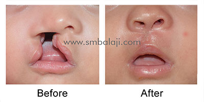 Primary lip repair for unilateral cleft lip & palate