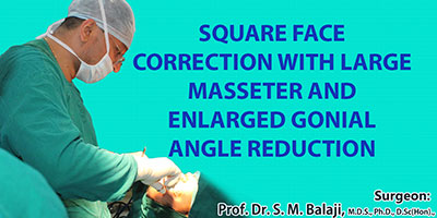 Square face correction with large masseter and enlarged gonial angle reduction