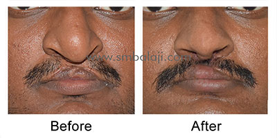 Successful surgical correction of the upper lip and nose defect using Abbe flap