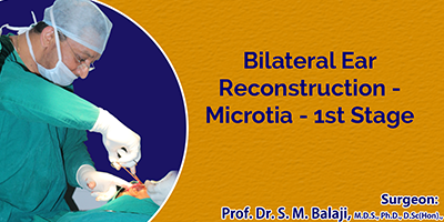 Bilateral Ear Reconstruction – Microtia – 1st Stage