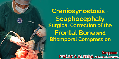 Craniosynostosis – Scaphocephaly Surgical Correction of the Frontal Bone and Bitemporal Compression