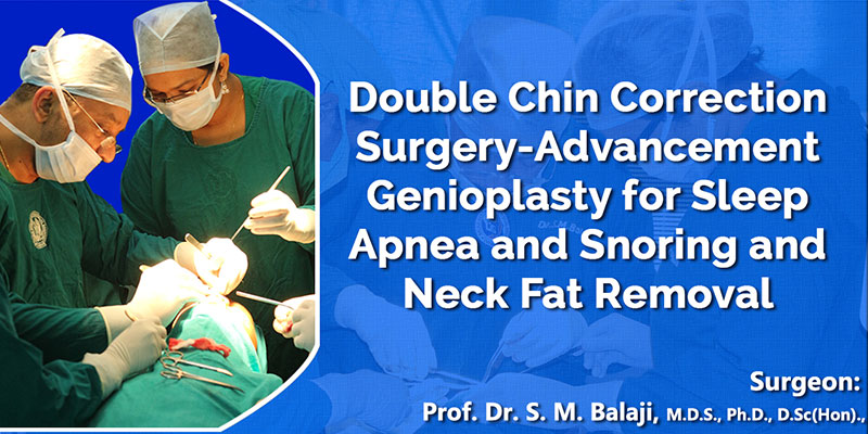 Double Chin Correction Surgery-Advancement Genioplasty for snoring and sleep apnea and Neck fat Removal