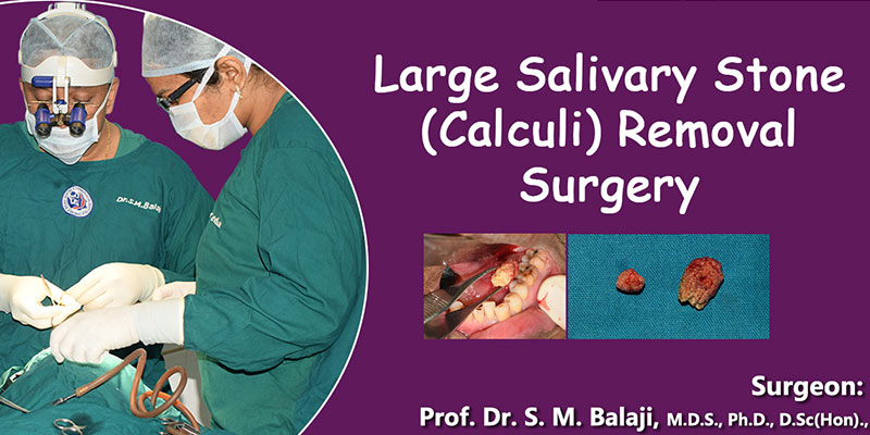 Large Salivary Stone (Calculi) Removal Surgery