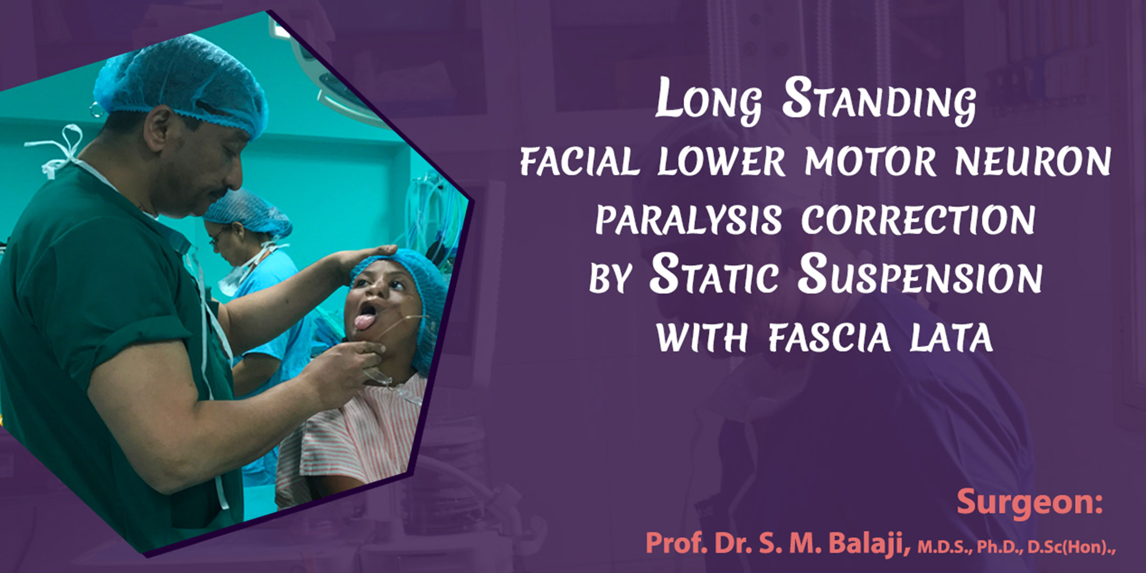 Long standing lower motor neuron facial paralysis correction by static suspension with fascia lata