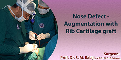 Nose Defect - Augmentation with Rib Cartilage graft