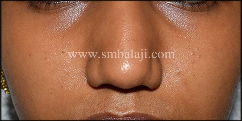 Best Nose Correction Surgery In India