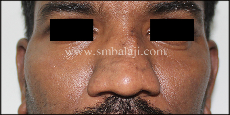 Best Rhinoplasty Surgery In India