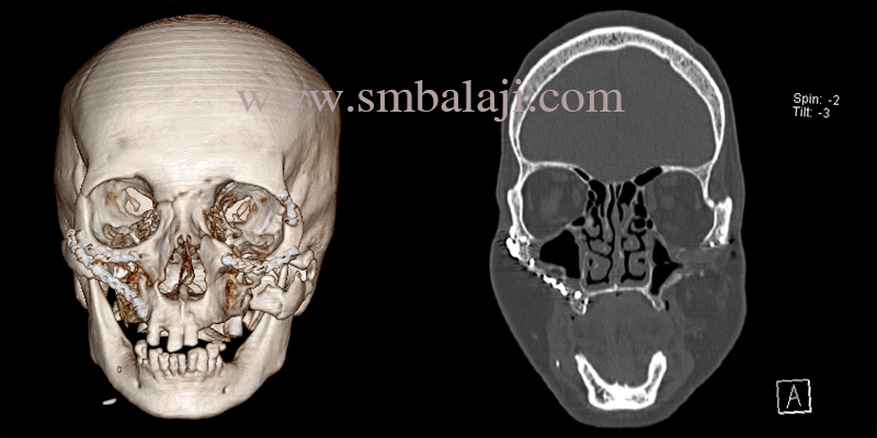 Facial Reconstruction Surgery In India