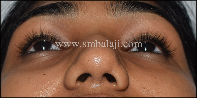 Best Nose Correction Surgery In India