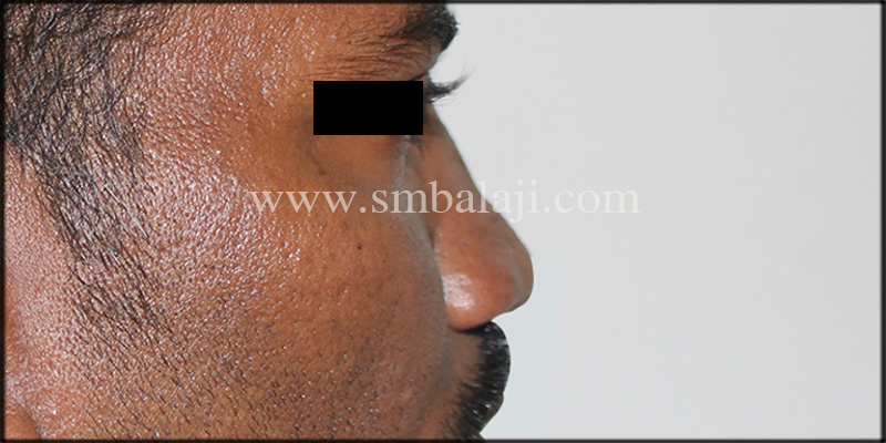 Best Rhinoplasty Surgery In India