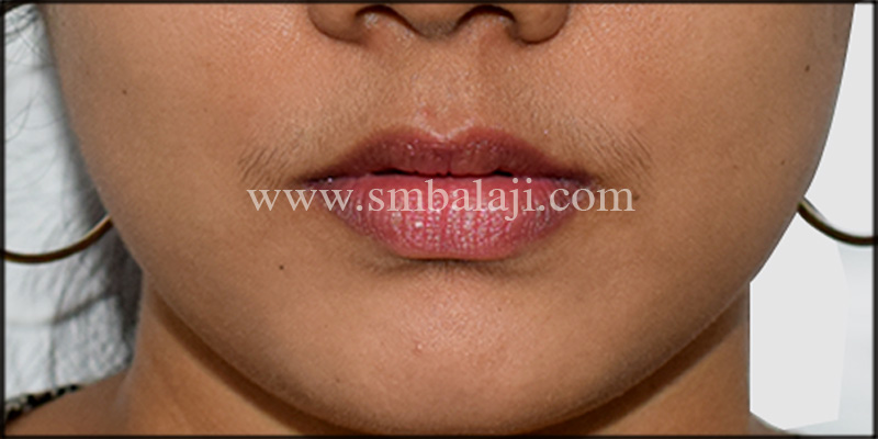 Best Jaw Surgery Hospital In India