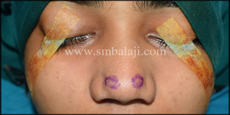 Best Rhinoplasty Surgery In India