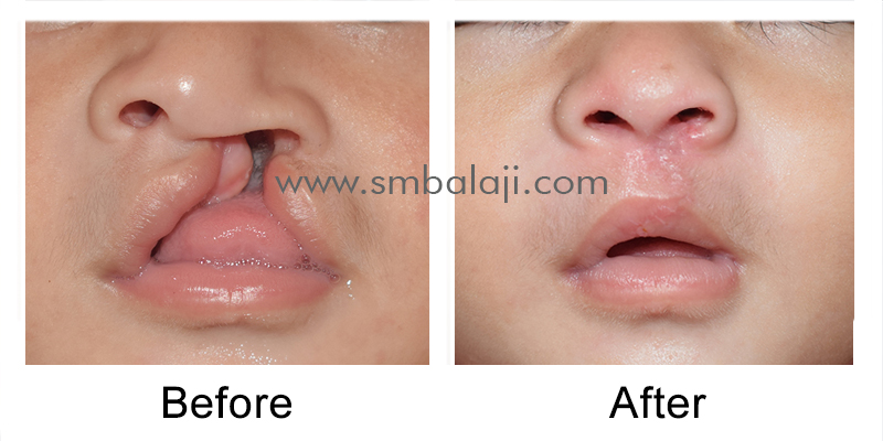 Cleft Lip Surgery In India