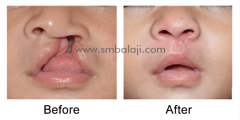 Unilateral cleft lip surgery using Modified Millard’s technique