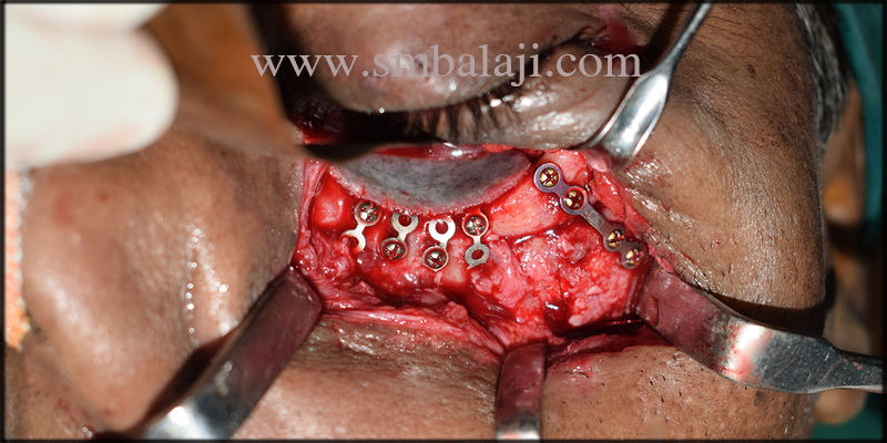 Maxillofacial Surgeon In India