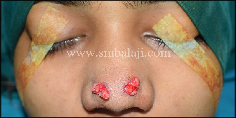 Best Rhinoplasty Surgery In India