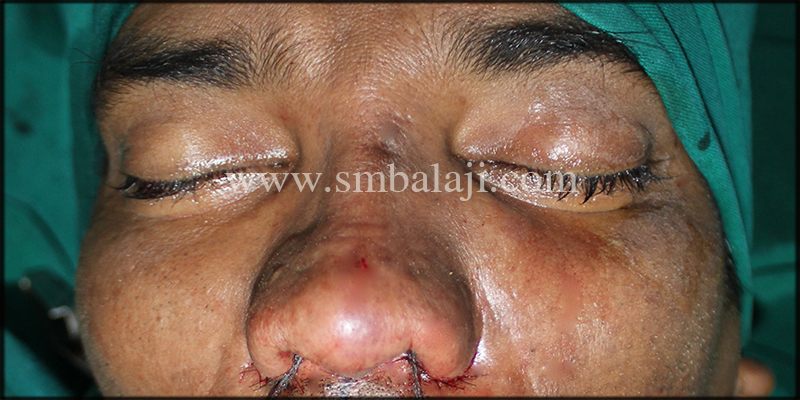 Best Rhinoplasty Surgeon In India