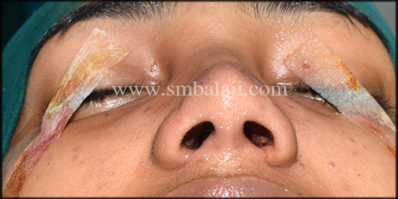 Scar Removal Surgery In India