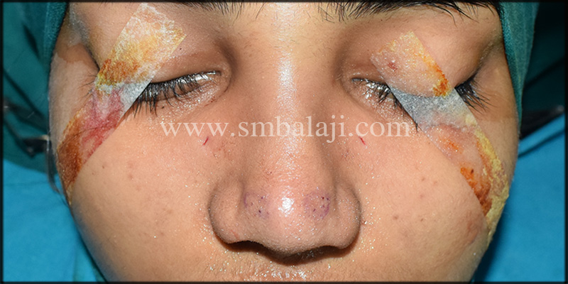 Scar Removal Surgery In India