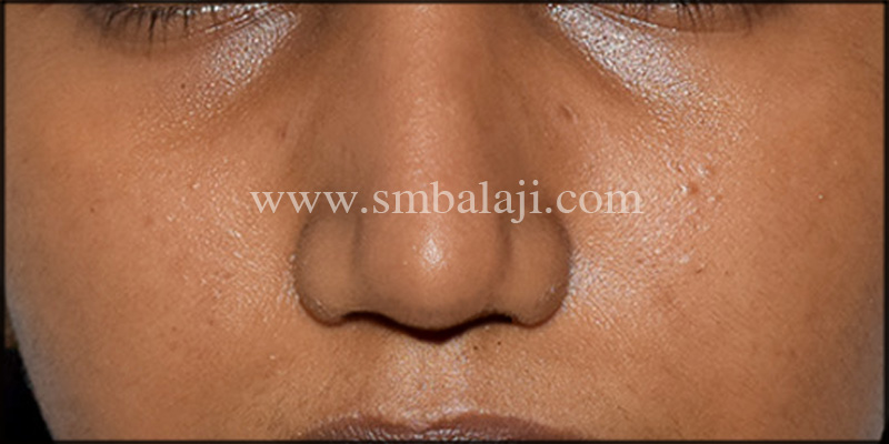 Nose Reshape Surgery In India