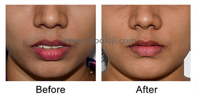 Corrective surgery for protruding upper jaw