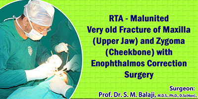 RTA – Malunited Very old Fracture of Maxilla (Upper Jaw) and Zygoma (Cheekbone) with Enophthalmos Correction Surgery