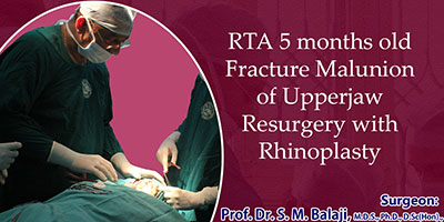 RTA 5 months old Fracture Malunion of Upper jaw Resurgery with Rhinoplasty