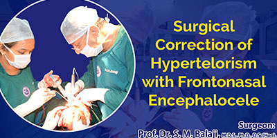 Hypertelorism Surgery in India
