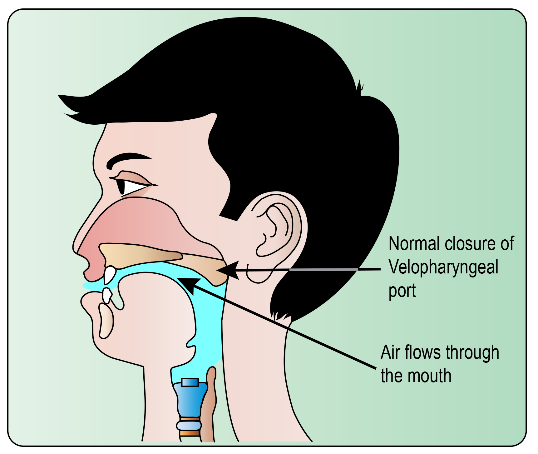 Pharyngoplasty Velopharyngeal Insufficiency