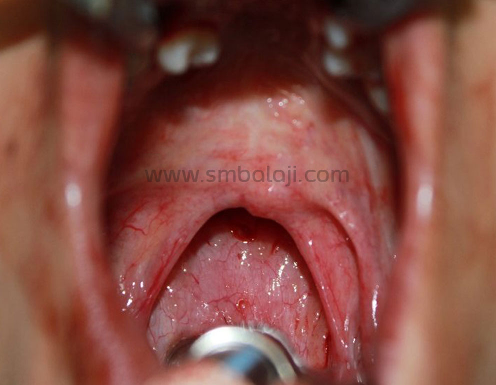 Pharyngoplasty India Before Picture