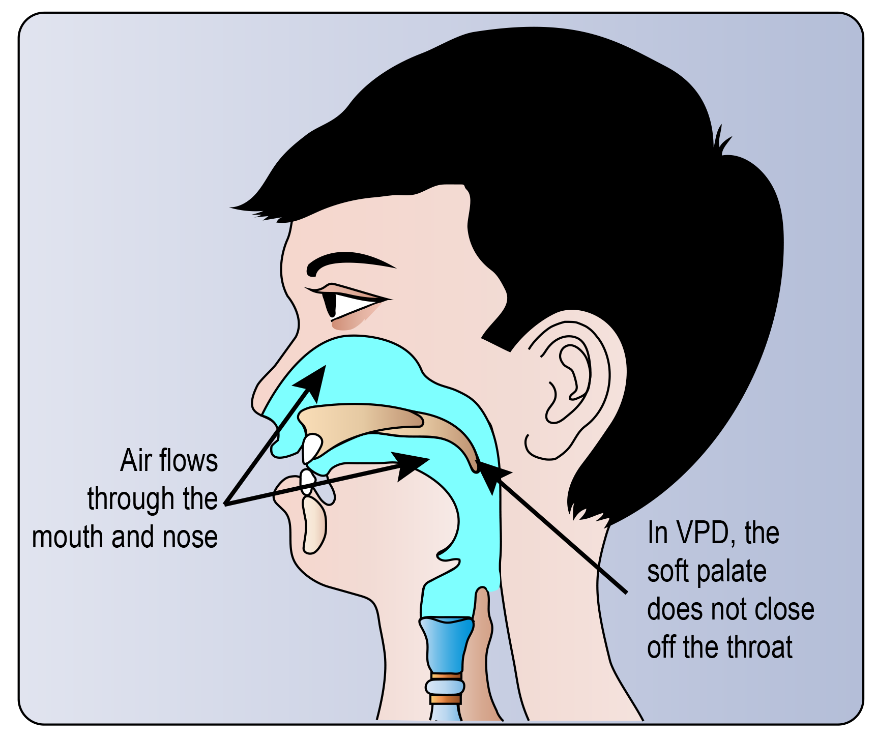 Velopharyngeal Insufficiency Pharyngoplasty