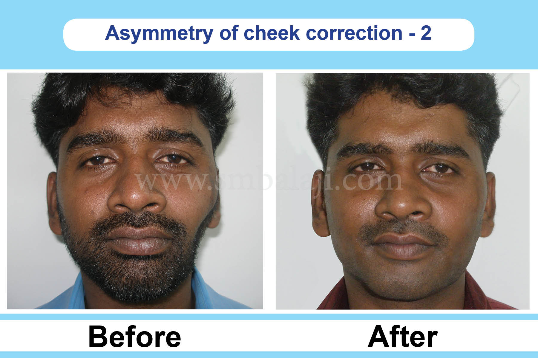 Cheekbone Augmentation Surgery India