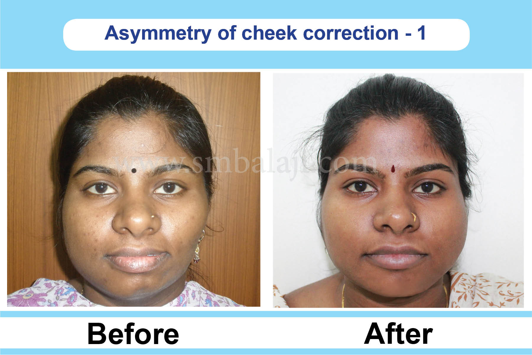 Cheekbone reduction surgery india Cheekbone Reduction Surgery India