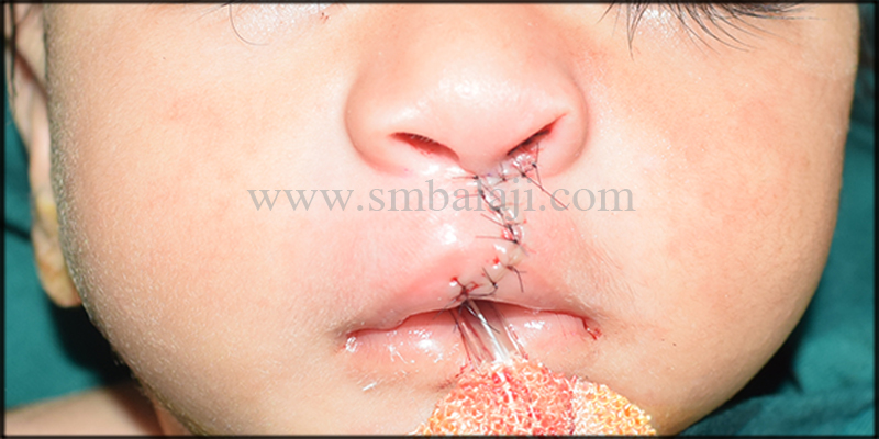 Best Cleft Lip Surgeon In Chennai