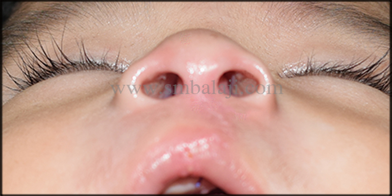 Post-Operative View Following 7 Days After Surgery Showing Negligible Scar Formation With Well Defined Nostrils - Worm'S View