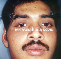 Eye Injuries 9 After Successful Surgery
