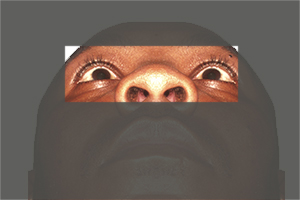Eye Injuries 6 After Surgery - Facial Trauma Surgery