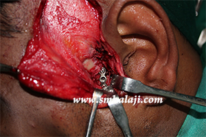 Jaw and TMJ Injuries 14 Bone Plate Adapted And Fixed To The Fractured Bone Segments On The Left Side