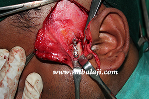 Jaw and TMJ Injuries 13 Bone Plate Adapted And Fixed To The Fractured Bone Segments