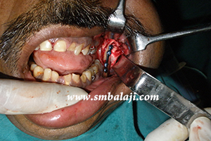 Jaw and TMJ Injuries 9 Bone Plate Fixed