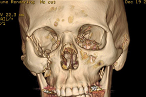 Eye Injuries 3 Ct Scan Image Showing Fractured Site