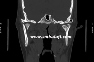 Jaw and TMJ Injuries 11 Ct Showing Condylar Neck Fracture On Both Sides And Displaced Inwards