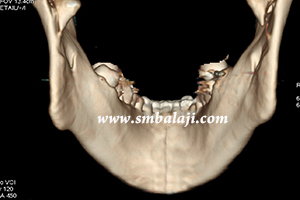 multiple facial jaw fractures Disloacted and