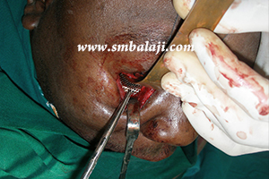 During Surgery-Eye Socket Reconstruction Using Titanium Mesh