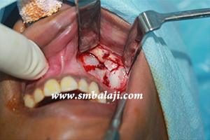 Jaw and TMJ Injuries 3 During Jaw Surgery