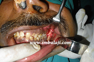 Jaw and TMJ Injuries 8 During Surgery, The Fracture Site Visualized